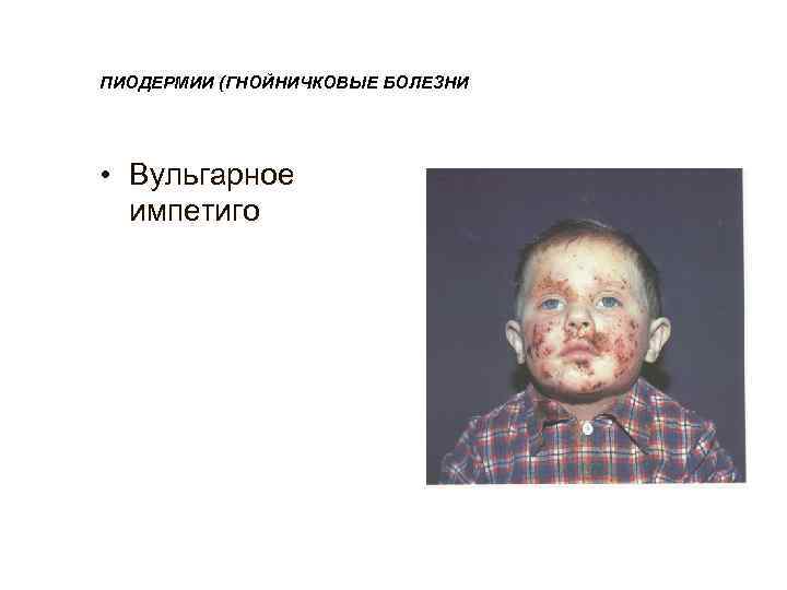 ПИОДЕРМИИ (ГНОЙНИЧКОВЫЕ БОЛЕЗНИ • Вульгарное  импетиго 
