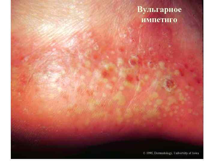 Вульгарное импетиго 