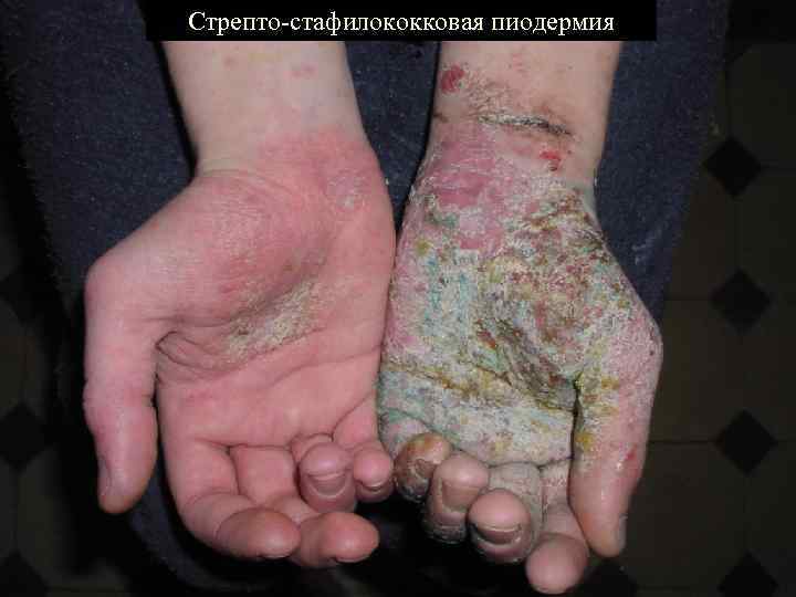 Стрепто-стафилококковая пиодермия 