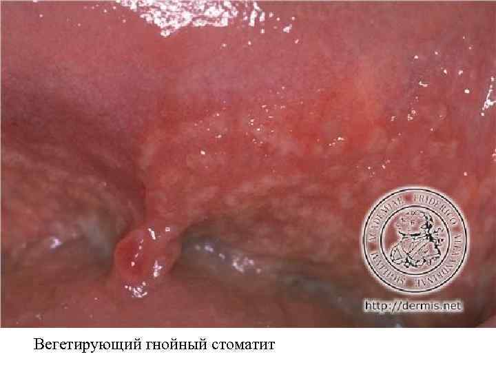 Вегетирующий гнойный стоматит 