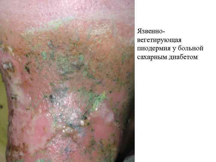 Язвенно- вегетирующая пиодермия у больной сахарным диабетом 
