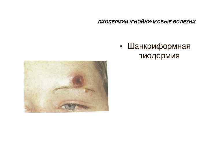 ПИОДЕРМИИ (ГНОЙНИЧКОВЫЕ БОЛЕЗНИ  • Шанкриформная  пиодермия 