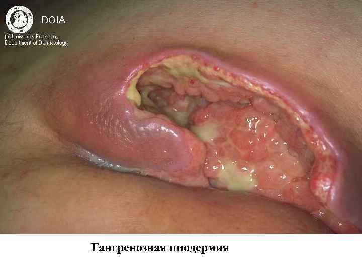 Гангренозная пиодермия 