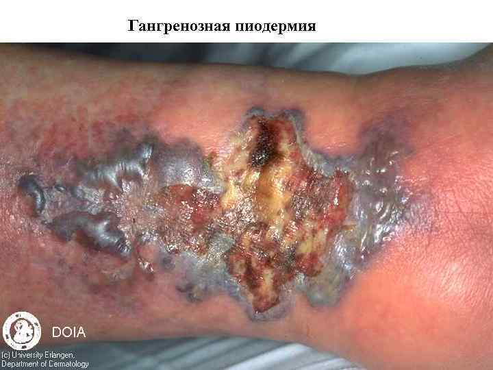 Гангренозная пиодермия 