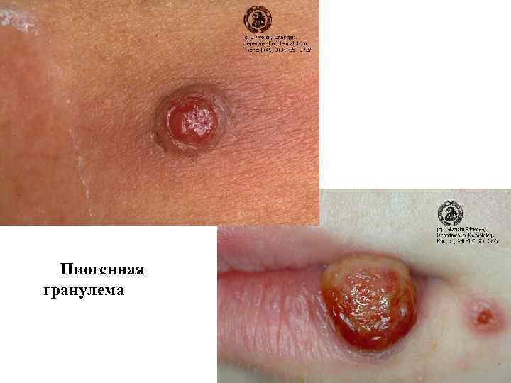  Пиогенная гранулема 