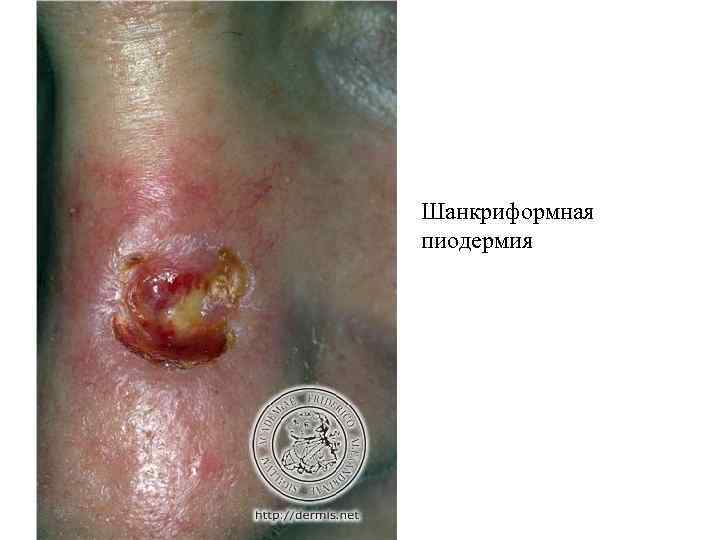Шанкриформная пиодермия 