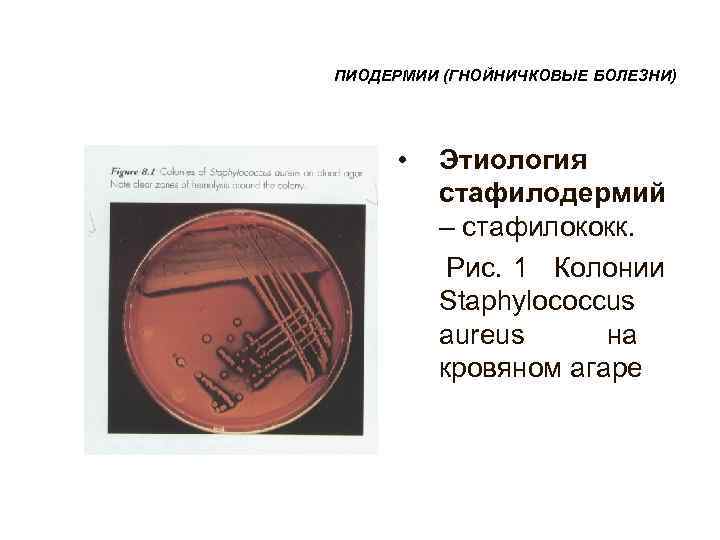 ПИОДЕРМИИ (ГНОЙНИЧКОВЫЕ БОЛЕЗНИ)  • Этиология  стафилодермий  – стафилококк.   Рис.