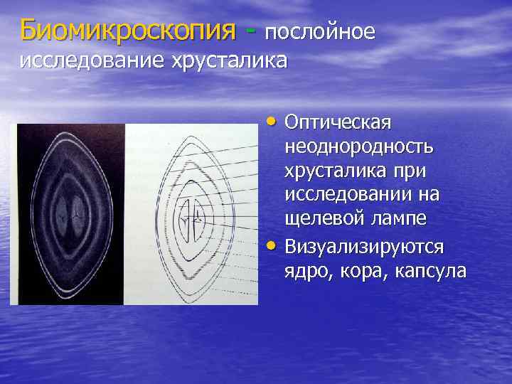 Биомикроскопия - послойное исследование хрусталика    • Оптическая    