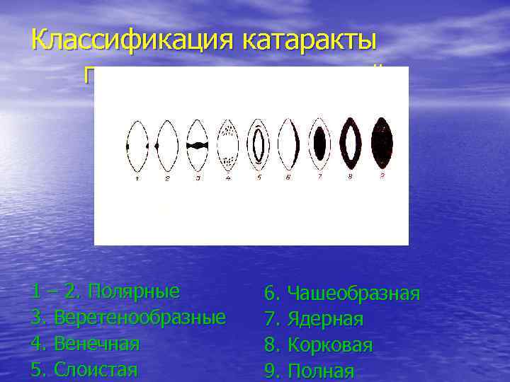 Классификация катаракты По локализации помутнений 1 – 2. Полярные  6. Чашеобразная 3. Веретенообразные