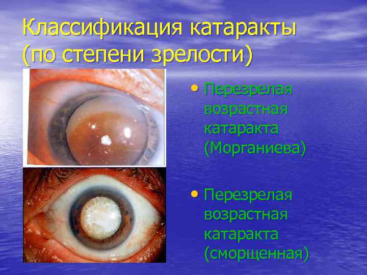 Классификация катаракты (по степени зрелости)    • Перезрелая    возрастная