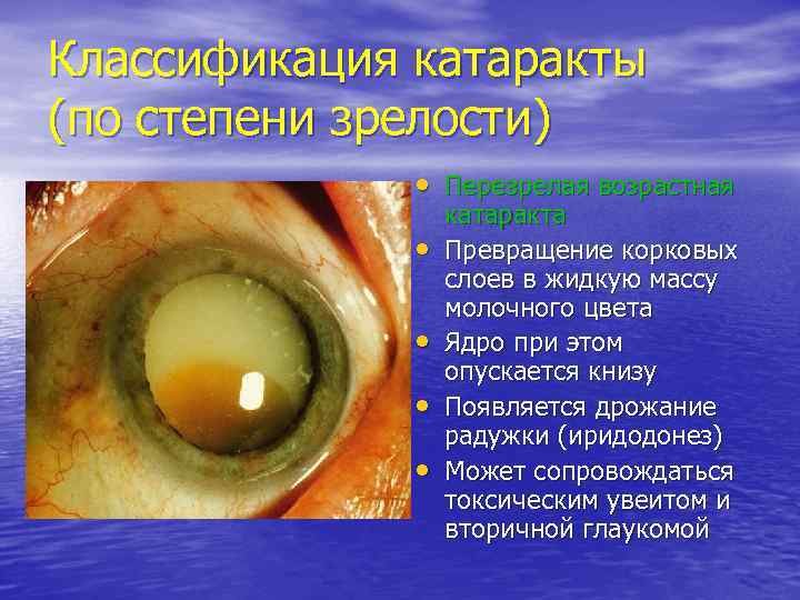Классификация катаракты (по степени зрелости)    • Перезрелая возрастная   
