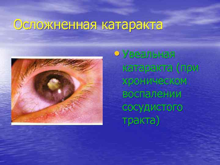 Осложненная катаракта   • Увеальная    катаракта (при   