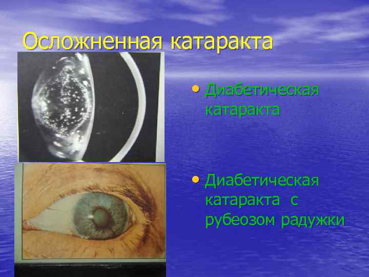 Осложненная катаракта   • Диабетическая    катаракта с   