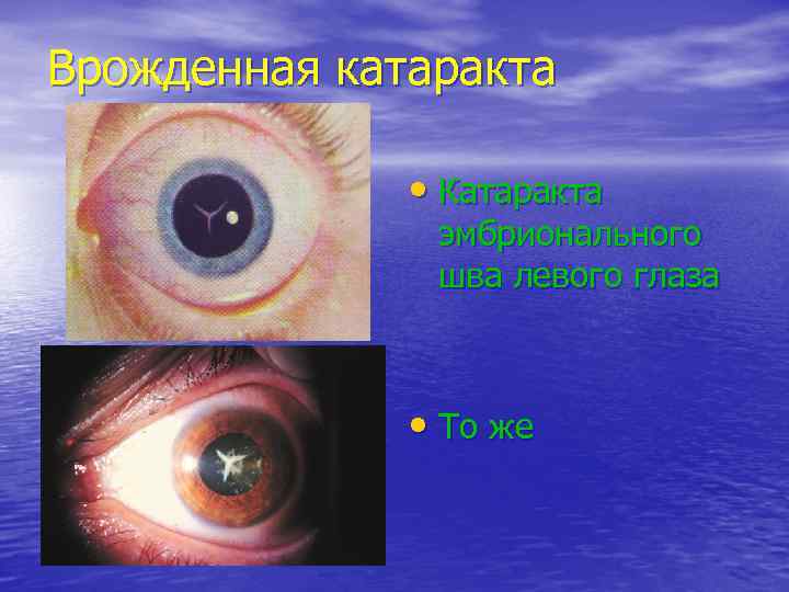 Врожденная катаракта   • Катаракта    эмбрионального    шва