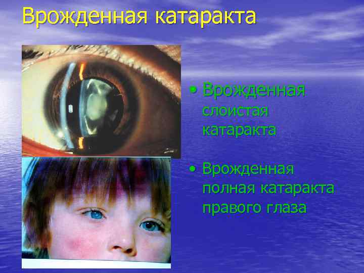 Врожденная катаракта   • Врожденная    слоистая    катаракта