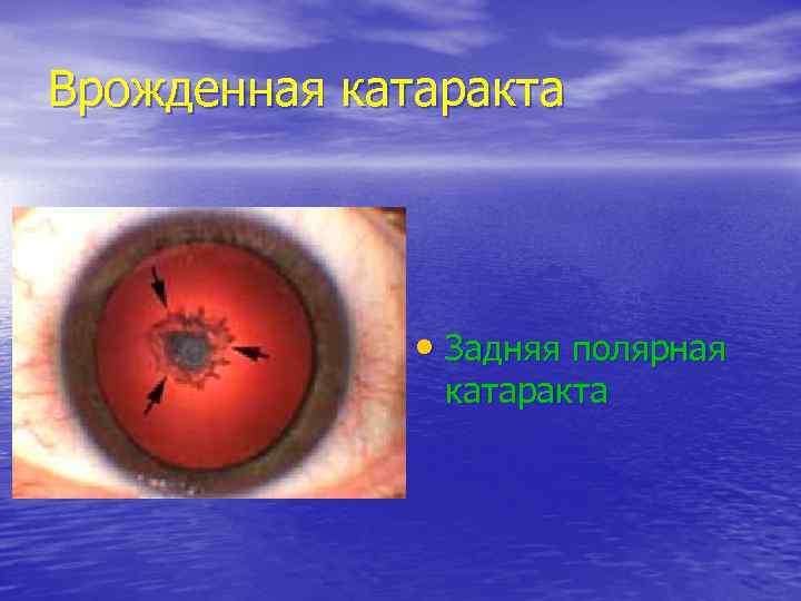 Врожденная катаракта    • Задняя полярная    катаракта 