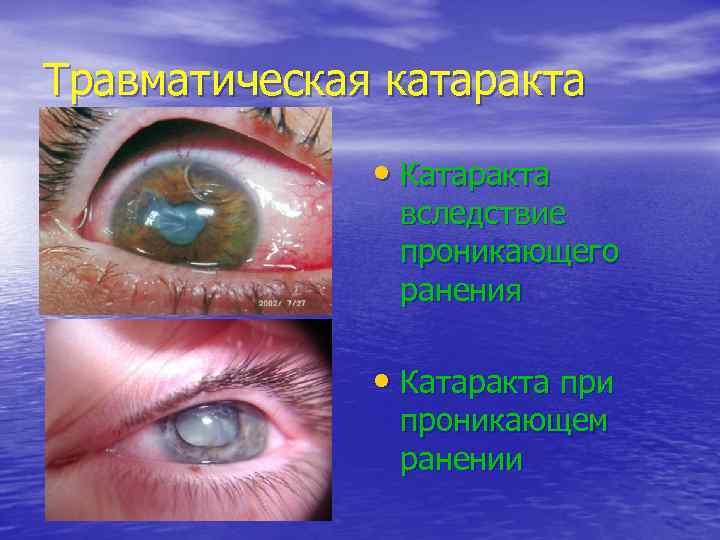 Травматическая катаракта   • Катаракта    вследствие    проникающего