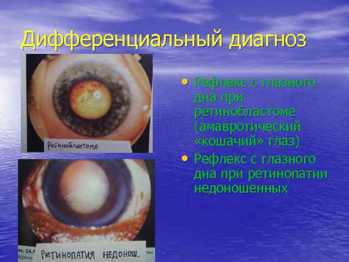 Дифференциальный диагноз    • Рефлекс с глазного   дна при 