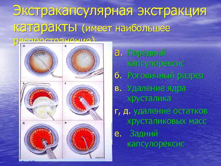 Экстракапсулярная экстракция катаракты (имеет наибольшее распространение)    a. Передний   