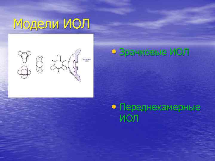 Модели ИОЛ    • Зрачковые ИОЛ   • Переднекамерные  