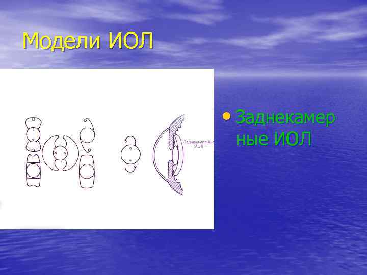 Модели ИОЛ   • Заднекамер    ные ИОЛ 