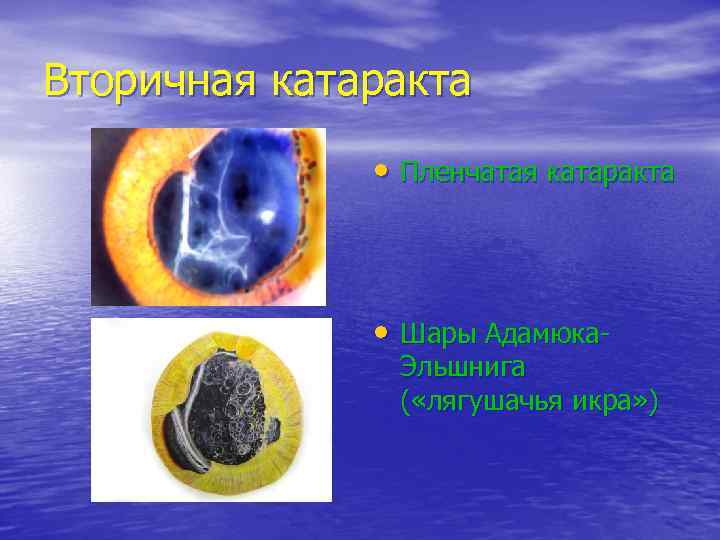 Вторичная катаракта    • Пленчатая катаракта    • Шары Адамюка-