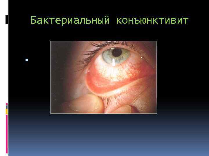 Бактериальный конъюнктивит 