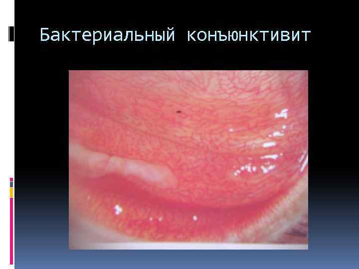 Бактериальный конъюнктивит 