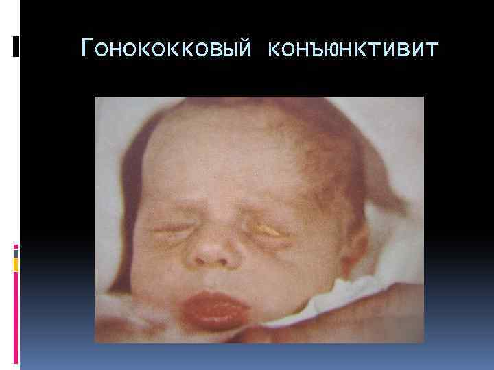 Гонококковый конъюнктивит 