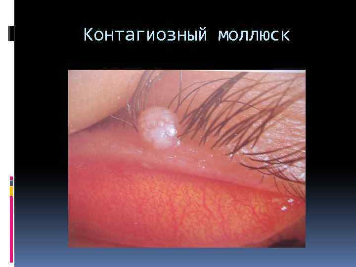 Контагиозный моллюск 