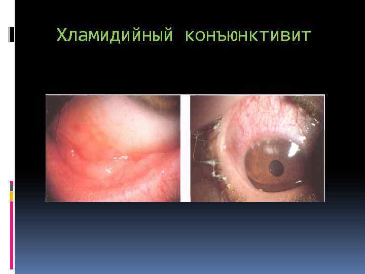 Хламидийный конъюнктивит 