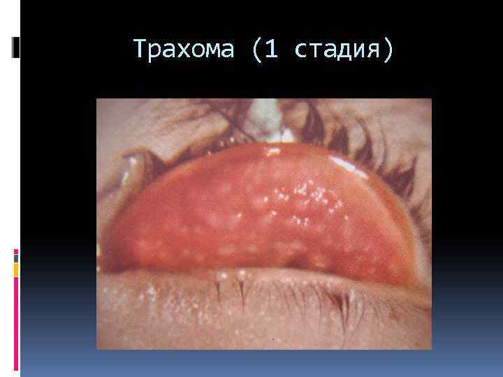 Трахома (1 стадия) 