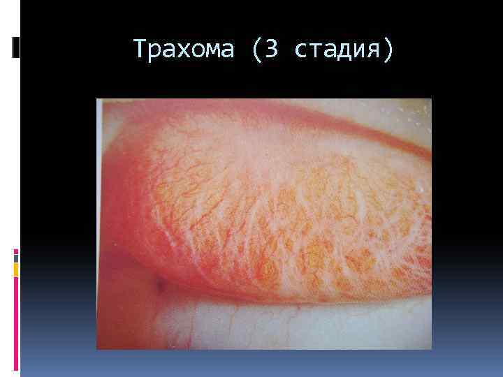 Трахома (3 стадия) 