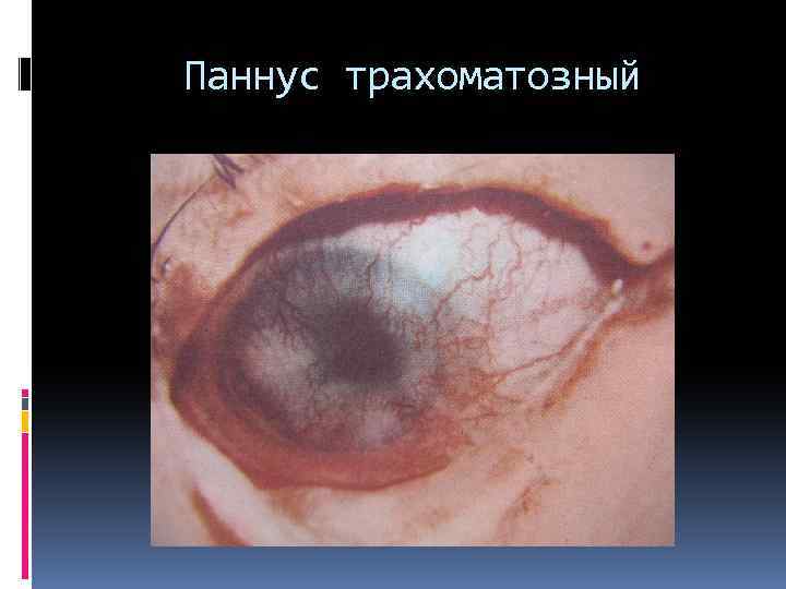 Паннус трахоматозный 