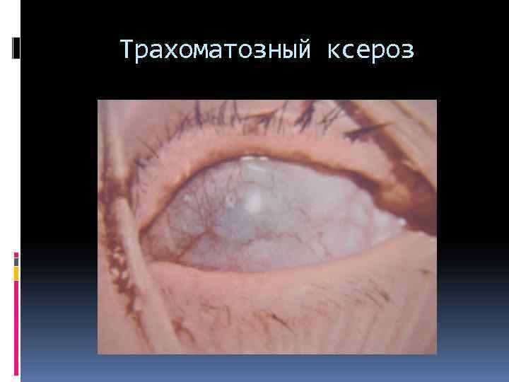 Трахоматозный ксероз 