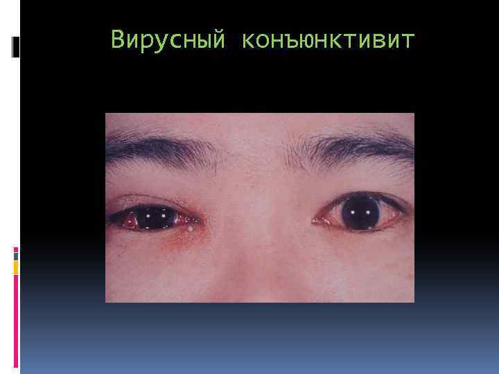 Вирусный конъюнктивит 