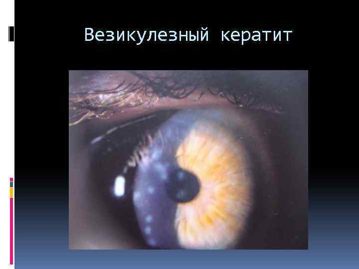 Везикулезный кератит 