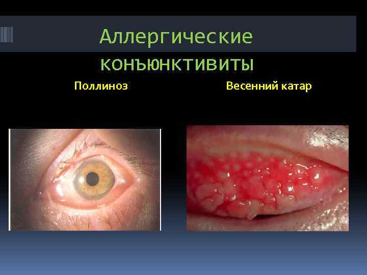 Аллергические конъюнктивиты Поллиноз Весенний катар 