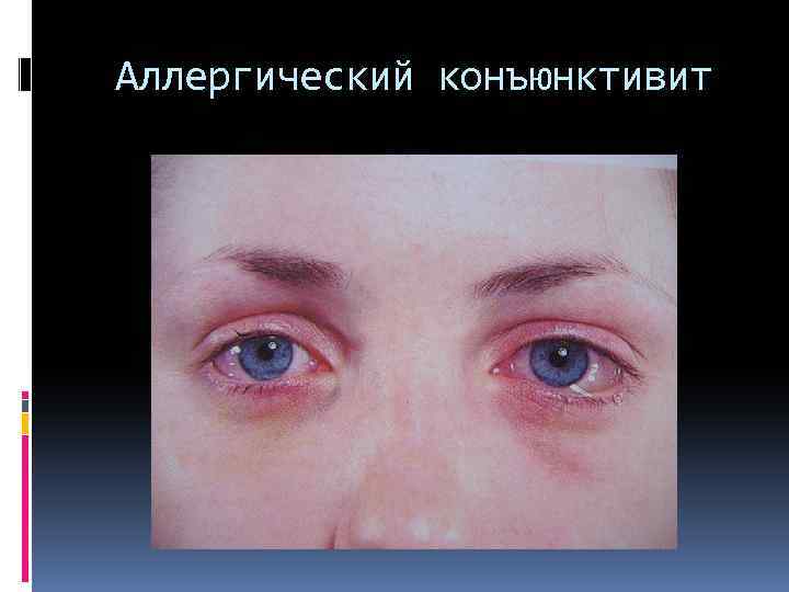 Аллергический конъюнктивит 