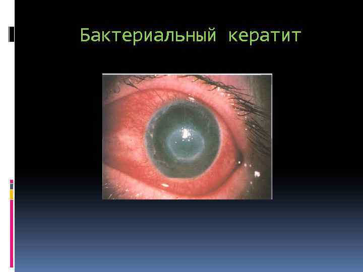 Бактериальный кератит 