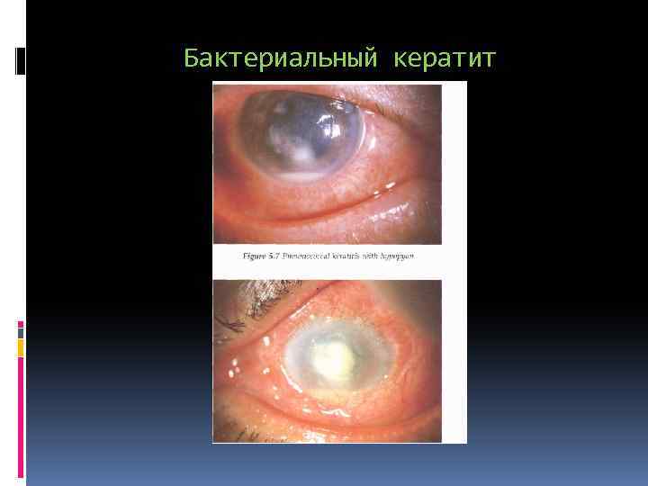 Бактериальный кератит 