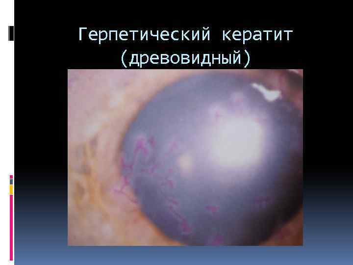 Герпетический кератит (древовидный) 