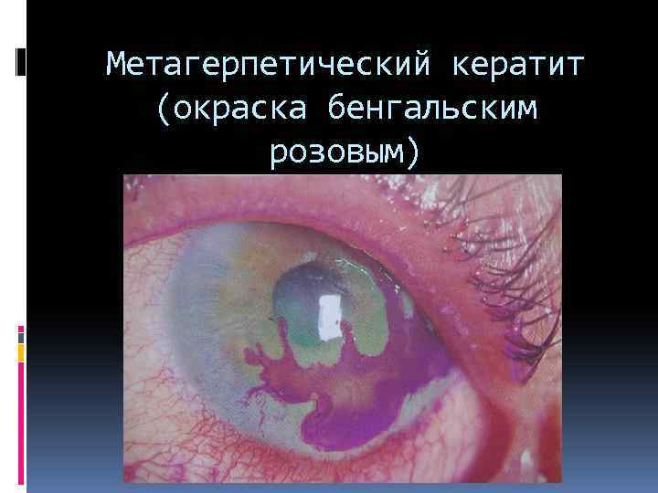 Метагерпетический кератит (окраска бенгальским розовым) 