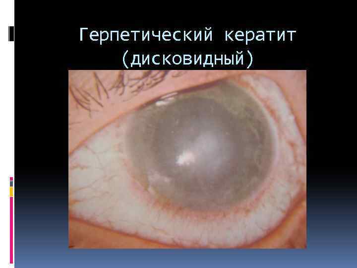 Герпетический кератит (дисковидный) 
