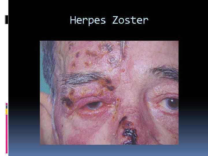 Herpes Zoster 