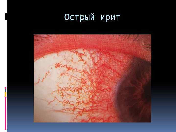 Острый ирит 