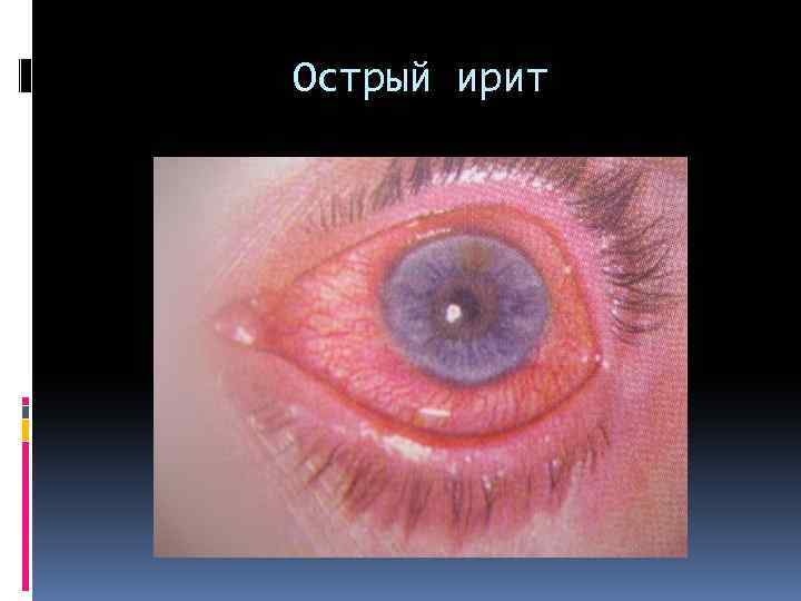 Острый ирит 