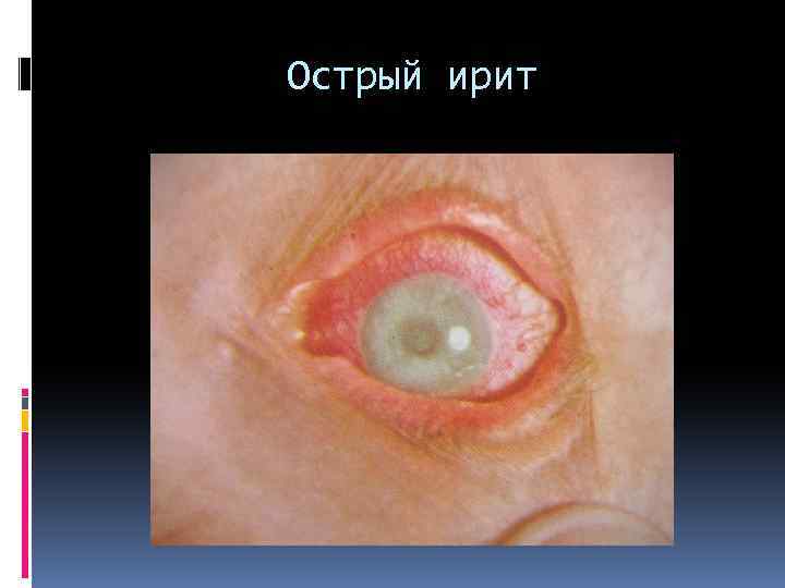 Острый ирит 