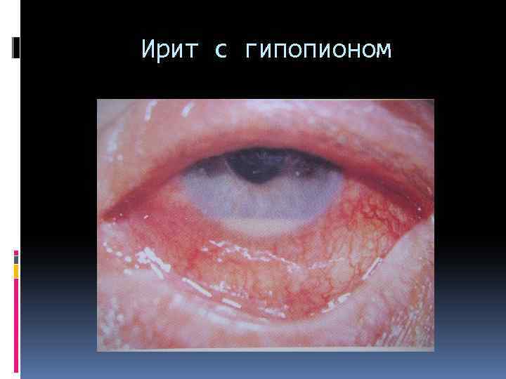 Ирит с гипопионом 