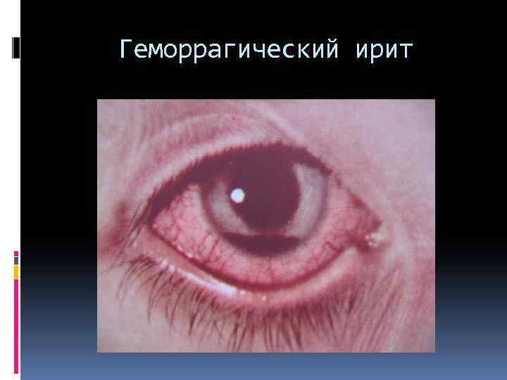 Геморрагический ирит 